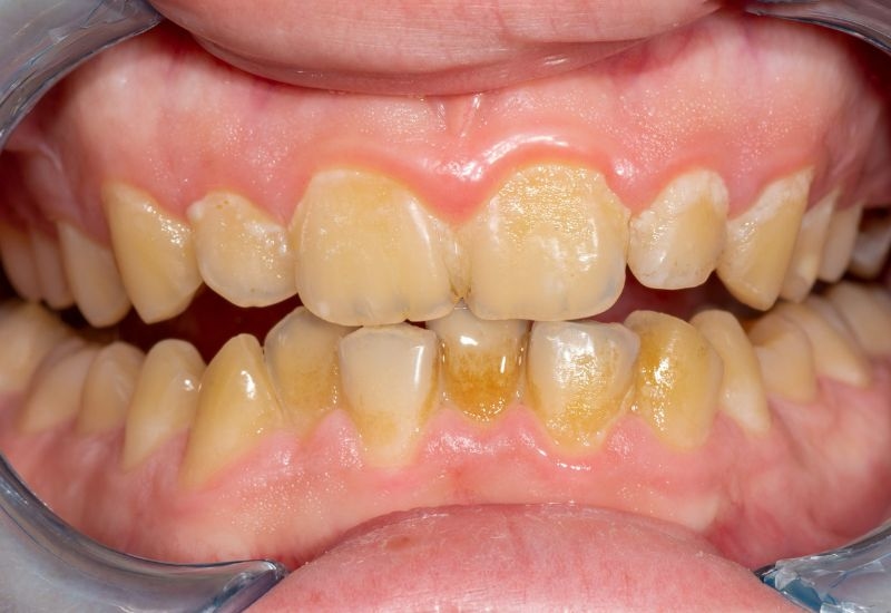 Cách trị sưng nướu răng trong cùng tại nhà - Vì sao nướu sưng ở trong cùng?