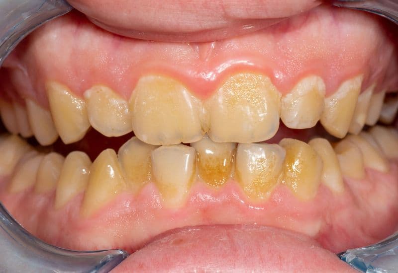 Cách trị sưng nướu răng trong cùng tại nhà - Vì sao nướu sưng ở trong cùng?