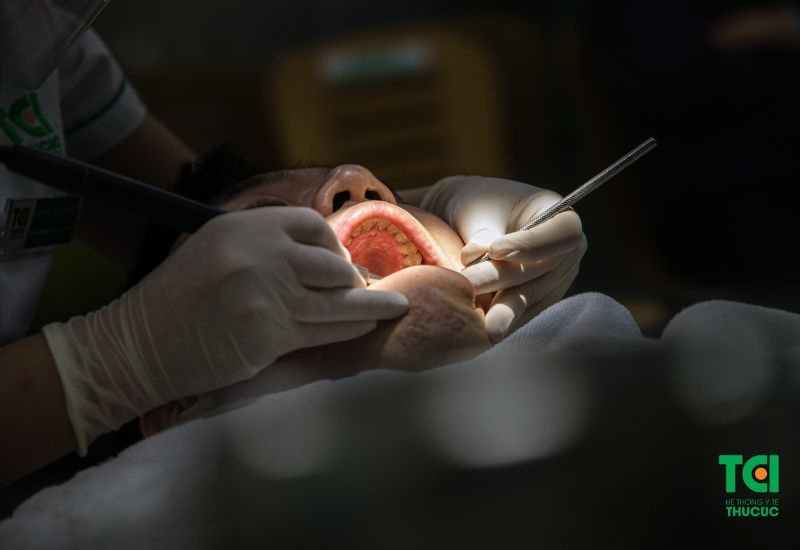 Cách trị cao răng màu đen hiệu quả