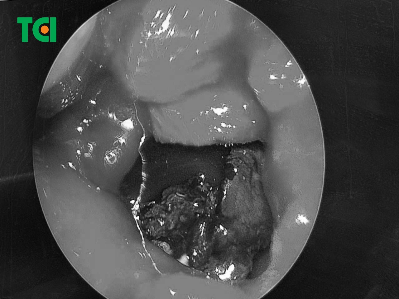 Hình ảnh nấm xoang được phát hiện khi nội soi