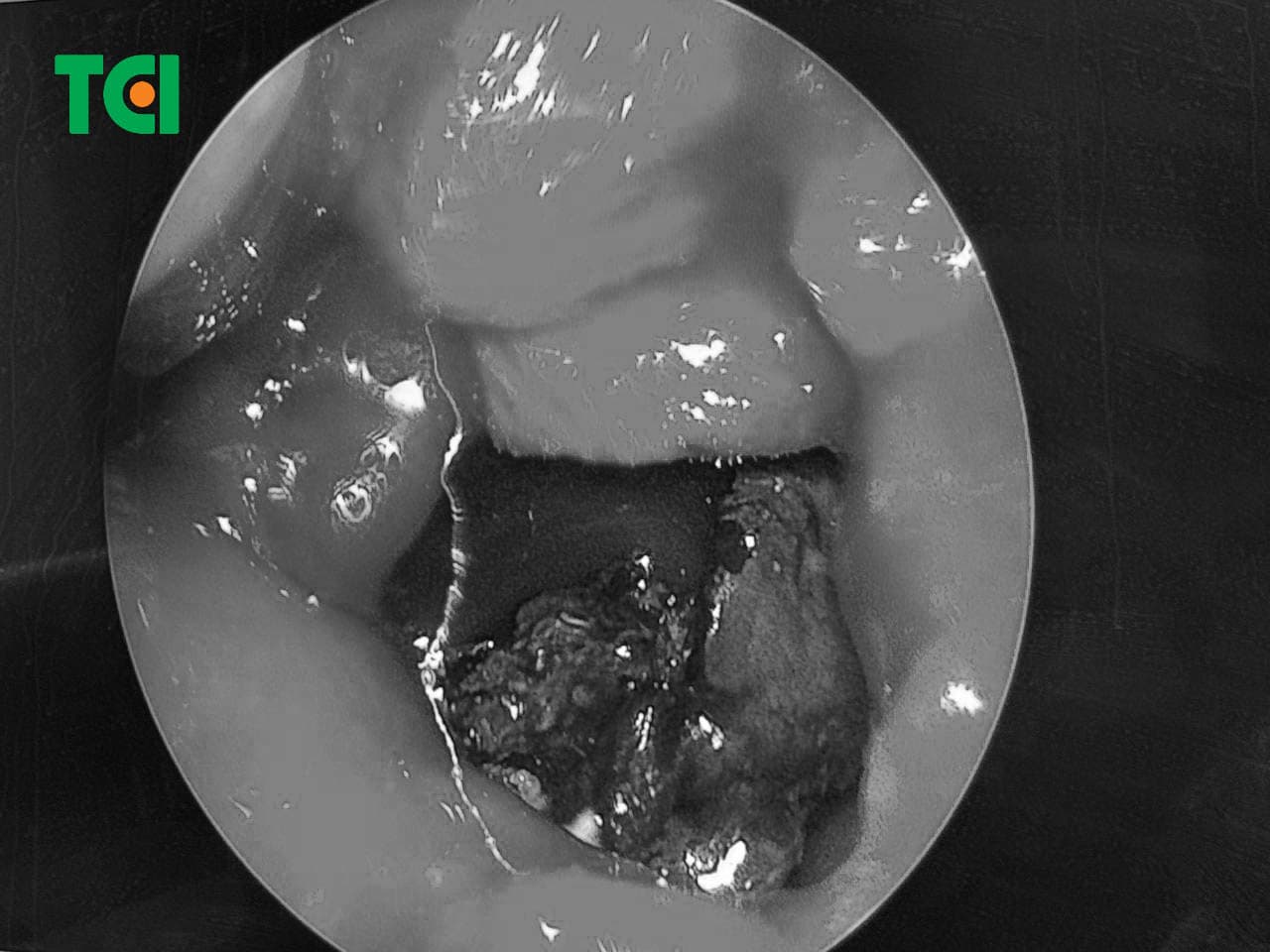 Hình ảnh nấm xoang được phát hiện khi nội soi