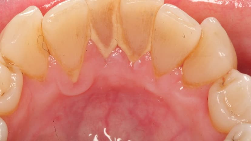 Tìm hiểu về vấn đề có nên lấy cao răng không