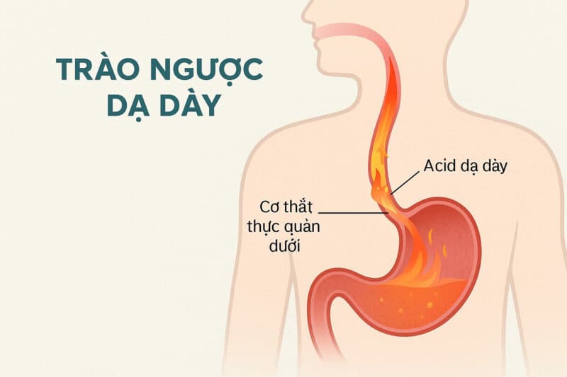 Trào ngược dạ dày cần chú ý chế độ ăn uống