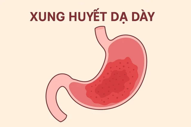 Giải đáp: Xung huyết dạ dày có nguy hiểm không