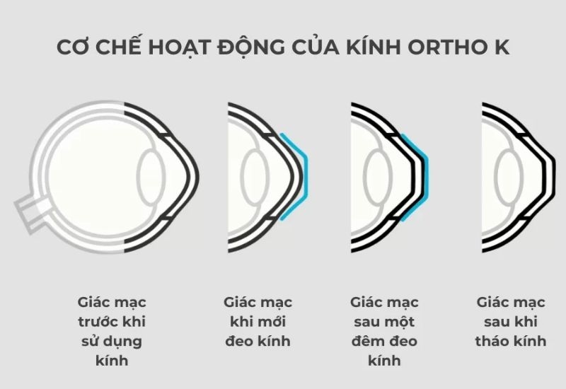 Kính Ortho K hoạt động như thế nào