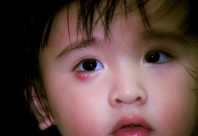 Lên lẹo mắt là bệnh gì