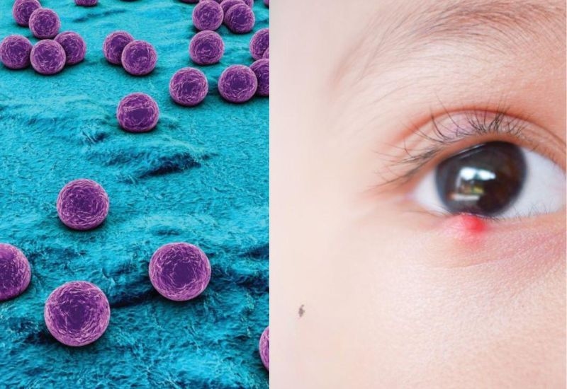 Nguyên nhân gây lên lẹo