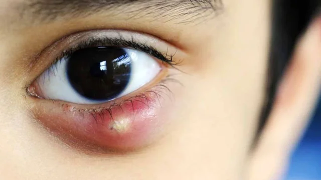 Lên lẹo ở mắt có tự khỏi không? Nguyên nhân và cách điều trị