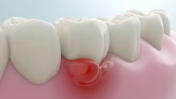 Lợi bị sưng: Dấu hiệu cảnh báo vấn đề răng miệng nghiêm trọng