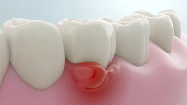 Lợi bị sưng: Dấu hiệu cảnh báo vấn đề răng miệng nghiêm trọng