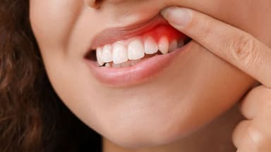 Lợi trùm: Nguyên nhân, dấu hiệu và cách điều trị hiệu quả