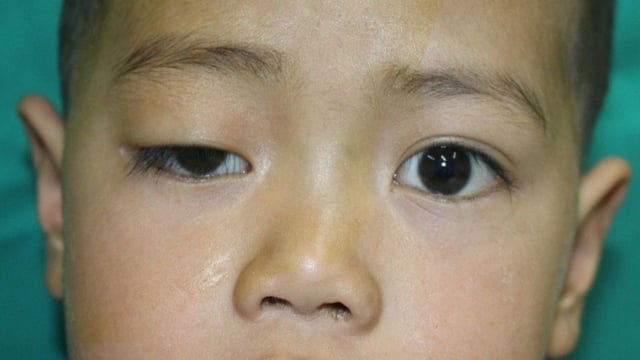 Mắt sụp mí có nguy hiểm không? Cách khắc phục nhanh, an toàn