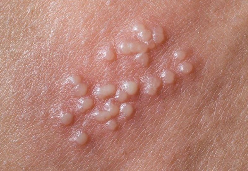 Dấu hiệu nhận diện mụn herpes