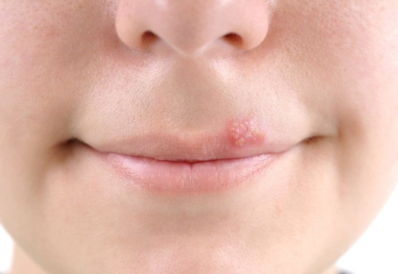 Mụn herpes tái phát