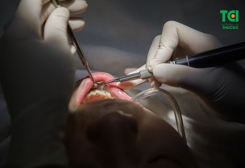 Sâu răng nhẹ đánh răng có hết không - Cách điều trị sâu răng nhẹ hiệu quả nhất hiện nay