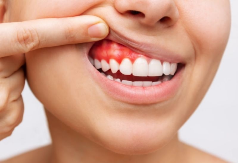 rủi ro nếu làm trắng răng tại nhà sai cách