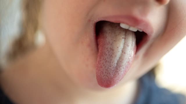 Trẻ bị nấm miệng: nguyên nhân, dấu hiệu, điều trị và phòng ngừa