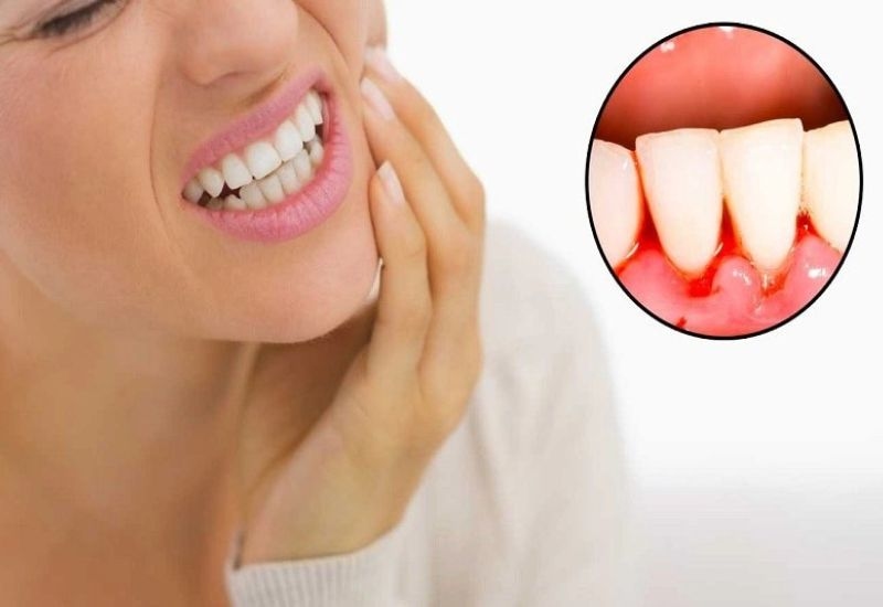 Viêm lợi răng là gì