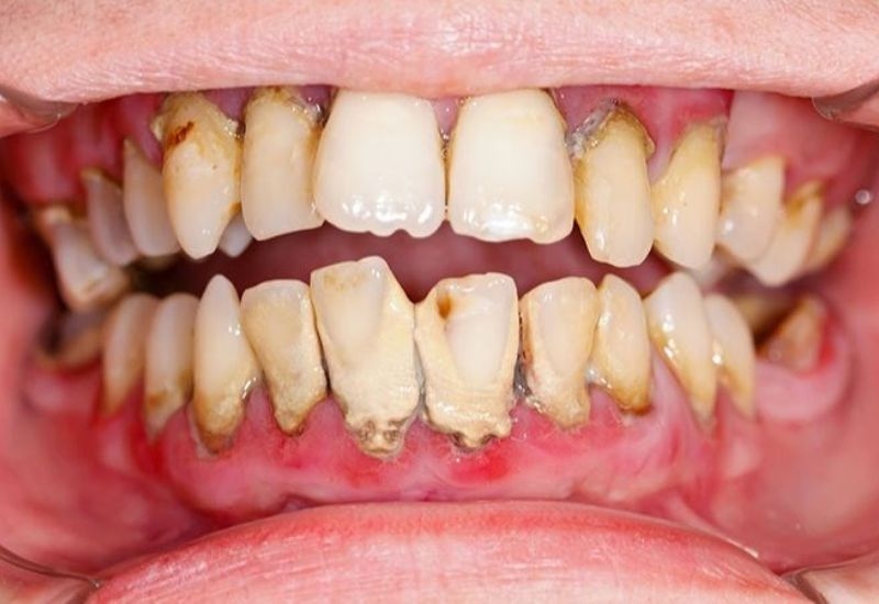 Nguy cơ biến chứng viêm lợi răng