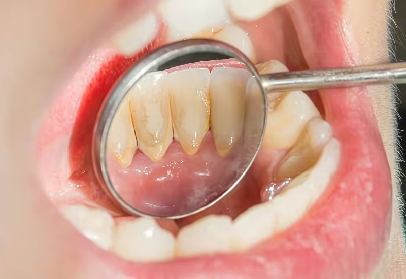 Nguyên nhân tiềm ẩn gây viêm lợi răng