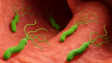 5 Biểu hiện của HP dạ dày: Nhận biết sớm phòng biến chứng