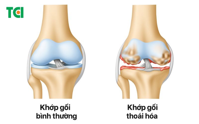 Các bệnh lý cơ xương khớp phổ biến