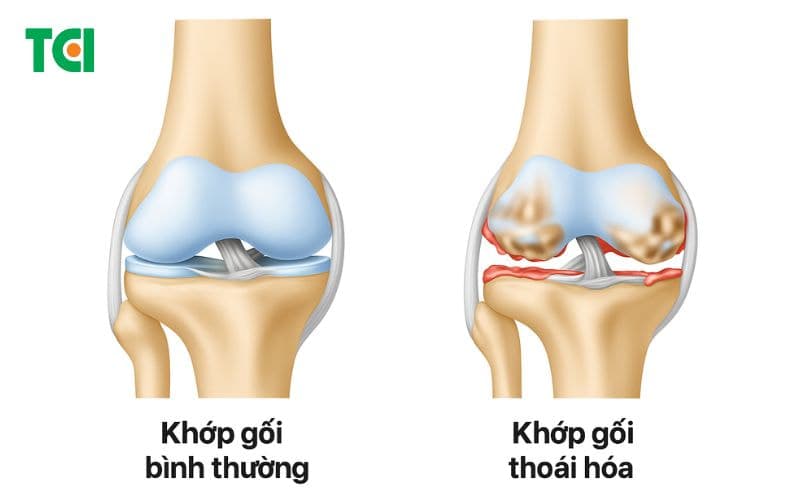 Các bệnh lý cơ xương khớp phổ biến