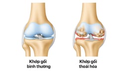 5 Bệnh lý cơ xương khớp phổ biến ở người Việt và cách điều trị