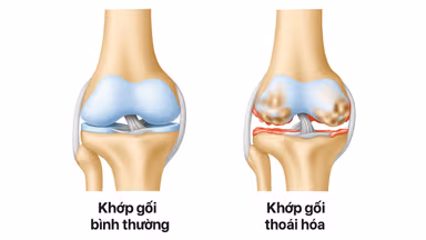 5 Bệnh lý cơ xương khớp phổ biến ở người Việt và cách điều trị
