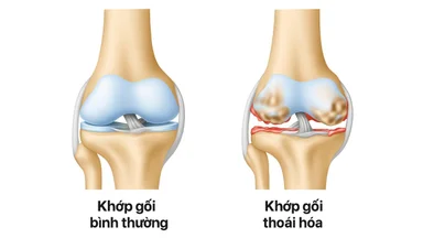 5 Bệnh lý cơ xương khớp phổ biến ở người Việt và cách điều trị