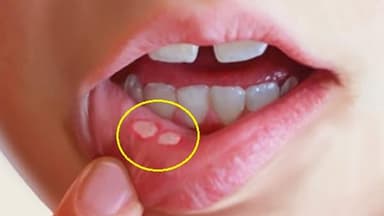 5 nguyên nhân khiến nhiệt lưỡi lâu ngày không khỏi