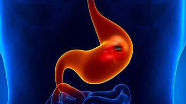 Biểu hiện của viêm loét dạ dày: triệu chứng và dấu hiệu biến chứng