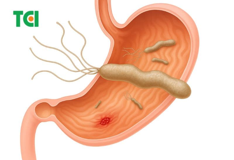 Vi khuẩn HP là nguyên nhân chủ yếu dẫn đến các tổn thương ở niêm mạc dạ dày, gây ra các biểu hiện của viêm loét dạ dày ở người.