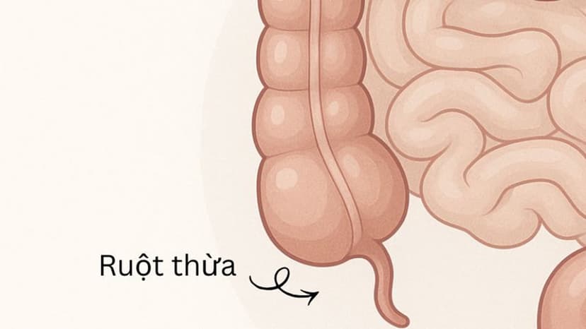 Cắt ruột thừa rồi có bị lại không: Giải đáp chi tiết