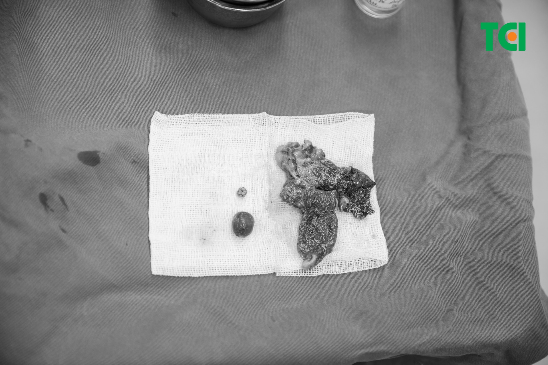 Người bệnh có sỏi túi mật gây đau, viêm tái phát nhiều lần hoặc ảnh hưởng tới chức năng gan mật