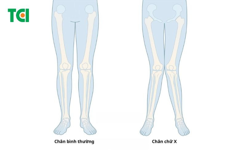 Chân chữ X là gì?