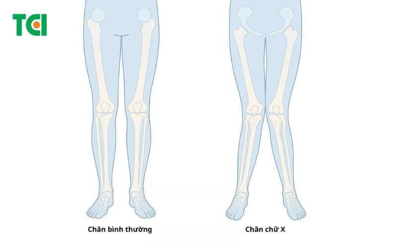 Chân chữ X là gì?
