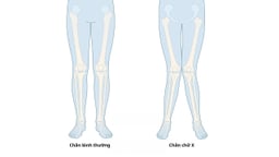 Chân chữ X: Nguyên nhân, dấu hiệu và cách khắc phục hiệu quả