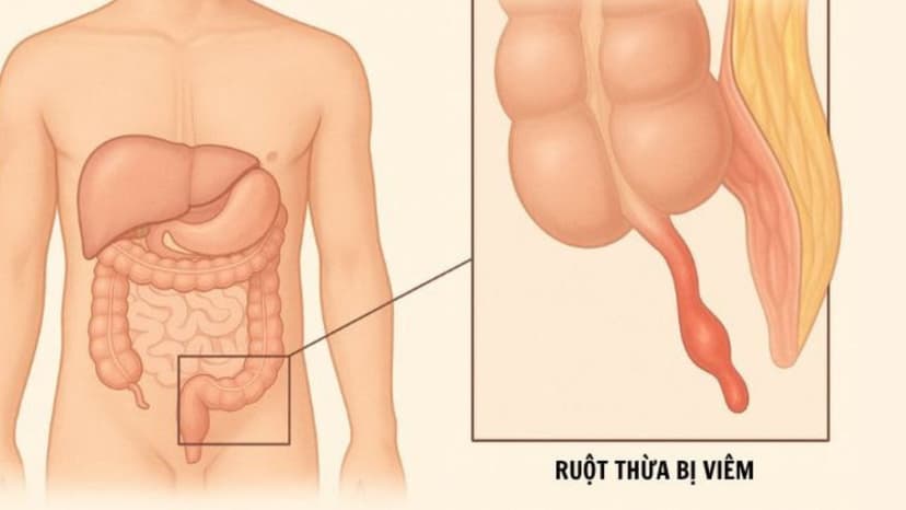 Chức năng ruột thừa và những điều cần biết về bệnh viêm ruột thừa