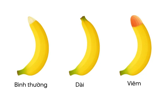 Dài bao quy đầu: Ảnh hưởng gì, có nên cắt không