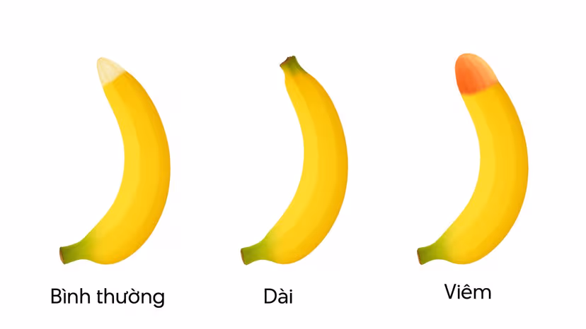 Dài bao quy đầu: Ảnh hưởng gì, có nên cắt không