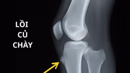 Lồi củ chày: Nguyên nhân, triệu chứng và cách điều trị hiệu quả