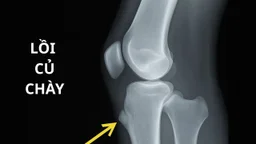 Lồi củ chày: Nguyên nhân, triệu chứng và cách điều trị hiệu quả