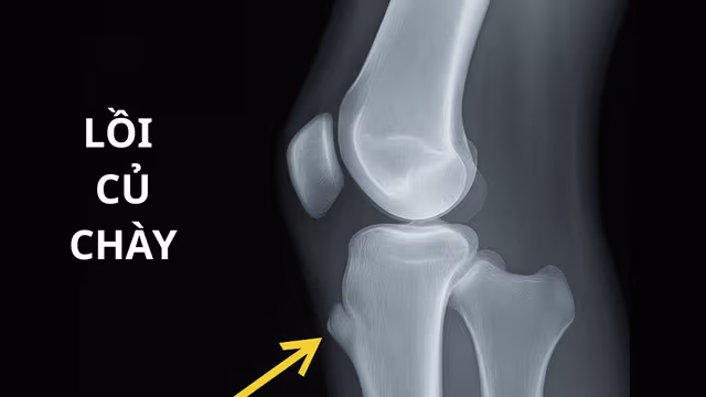 Lồi củ chày: Nguyên nhân, triệu chứng và cách điều trị hiệu quả
