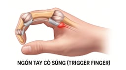 Ngón tay cò súng: Nguyên nhân, triệu chứng và cách khắc phục