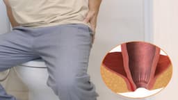 Rò hậu môn có đau không: Dấu hiệu nhận biết, cách điều trị