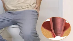 Rò hậu môn có đau không: Dấu hiệu nhận biết, cách điều trị