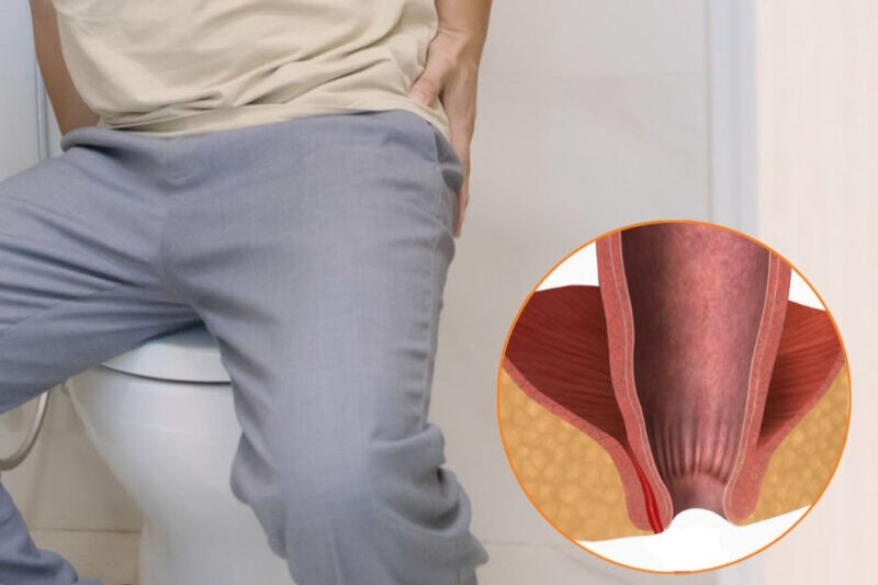 Người bị rò hậu môn thường xuất hiện cảm giác đau và sưng tấy quanh vùng hậu môn