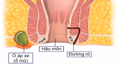 Rò hậu môn và áp xe hậu môn: Phân biệt và điều trị