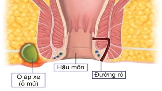Rò hậu môn và áp xe hậu môn: Phân biệt và điều trị